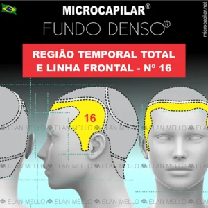 Microcapilar® Fundo Denso® na Região Temporal Total e Linha Frontal – #16