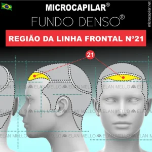 Microcapilar® Fundo Denso® na Região da Linha Fronta (hairline) - n.º 21