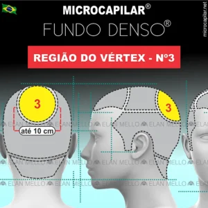 Microcapilar® Fundo Denso® na Região do Vértex #3