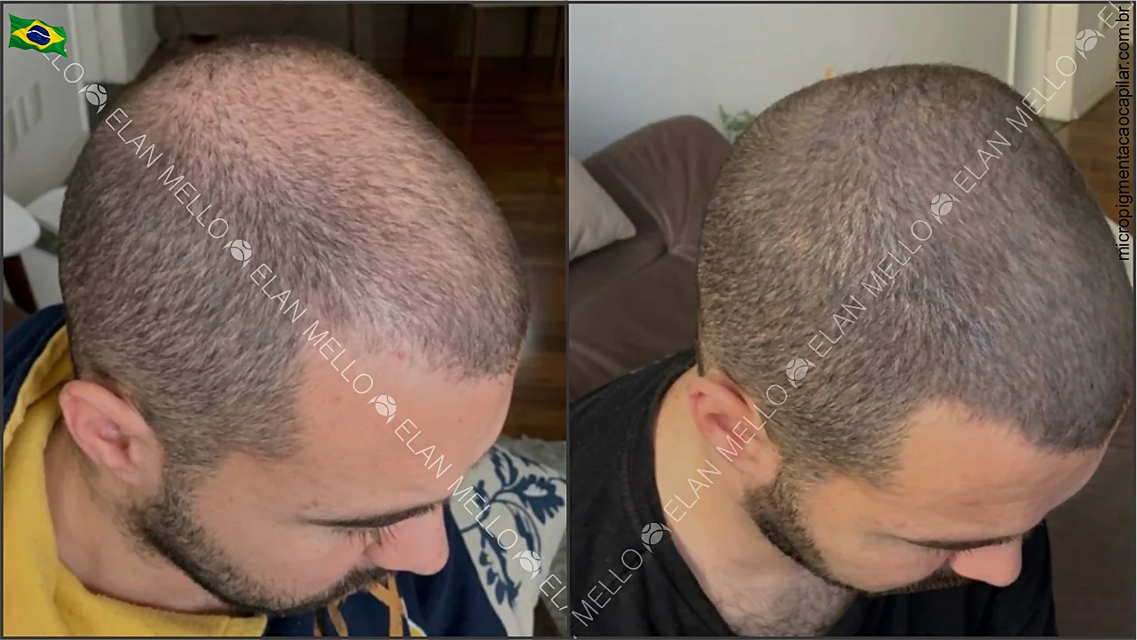 Microcapilar® Fundo Suave Interativo® - Imagem 6