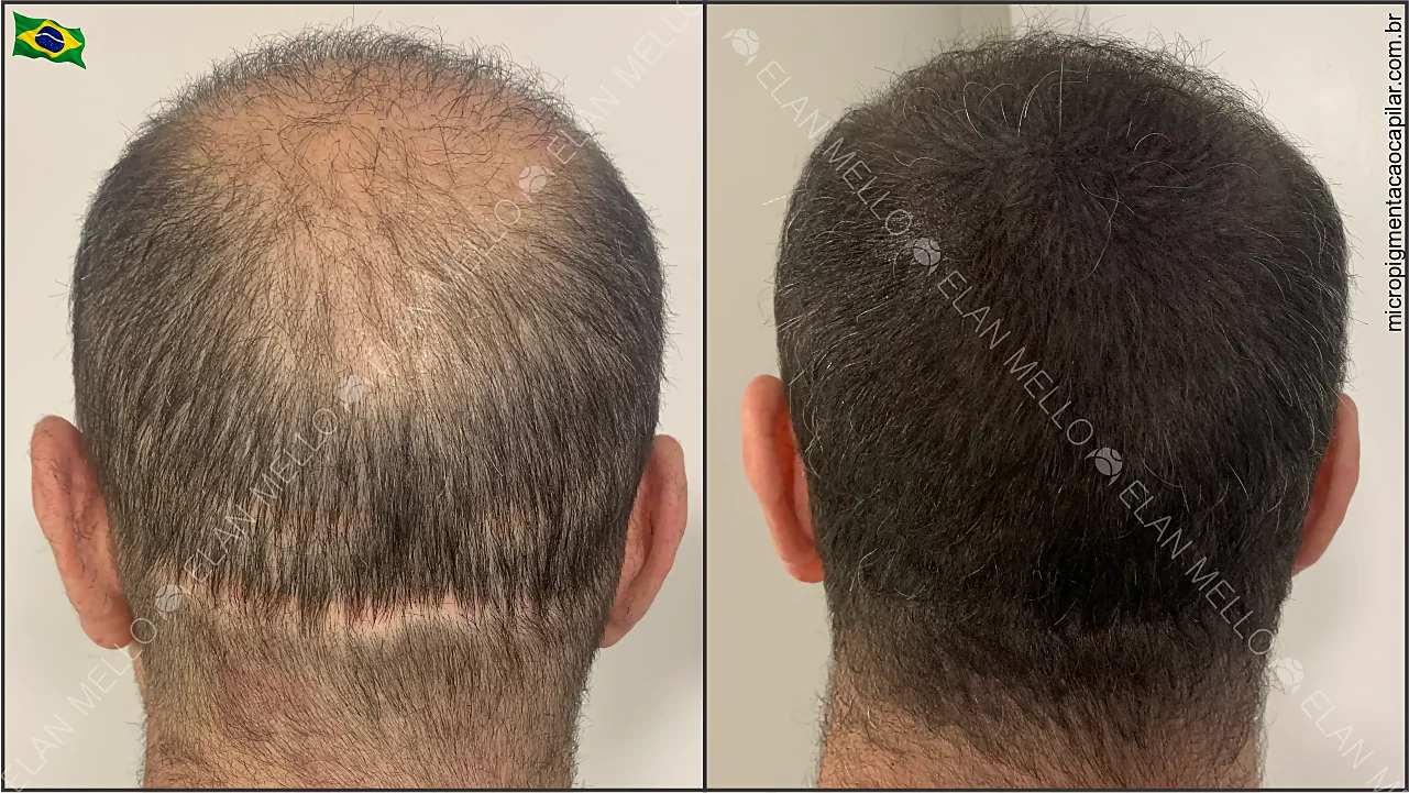 Microcapilar® Fundo Suave Interativo® - Imagem 4