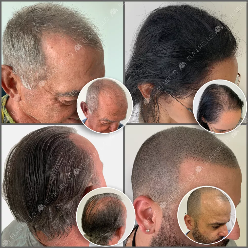 Quatro pessoas exibindo técnicas capilares diferentes. Dois homens e uma mulher com cabelos longos mostram micropigmentação capilar para densidade, enquanto um homem com cabelo raspado apresenta a técnica fio a fio.