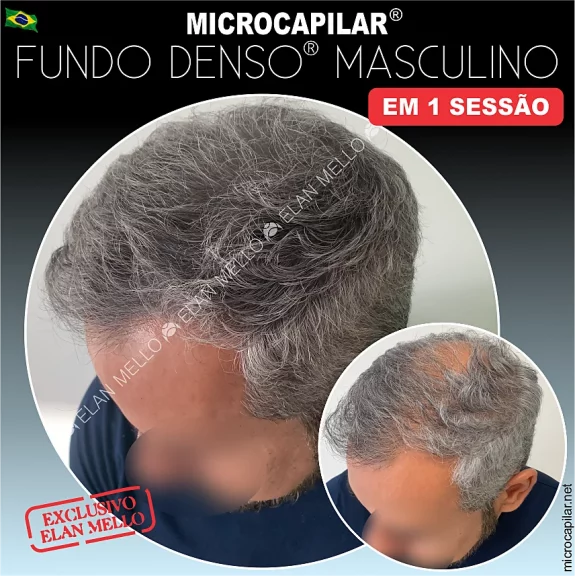 <b>Microcapilar® Fundo Denso®</b>