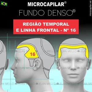 Microcapilar® Fundo Denso® na Região da Linha Frontal e Temporal – #16