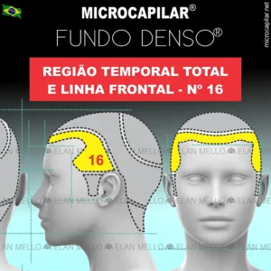 Microcapilar® Fundo Denso® na Região Temporal Total e Linha Frontal – #16