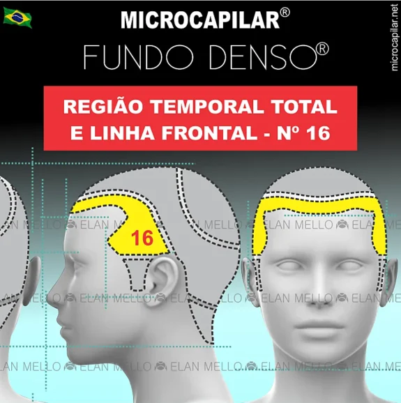 Microcapilar® Fundo Denso® na Região Temporal Total e Linha Frontal – #16