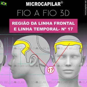 Microcapilar® Fio a Fio na Região da Linha Frontal e Linha Temporal – #17