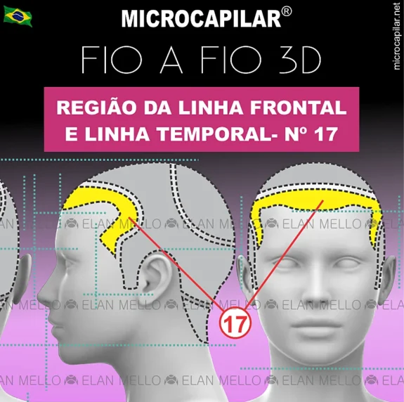 Microcapilar® Fio a Fio na Região da Linha Frontal e Linha Temporal – #17